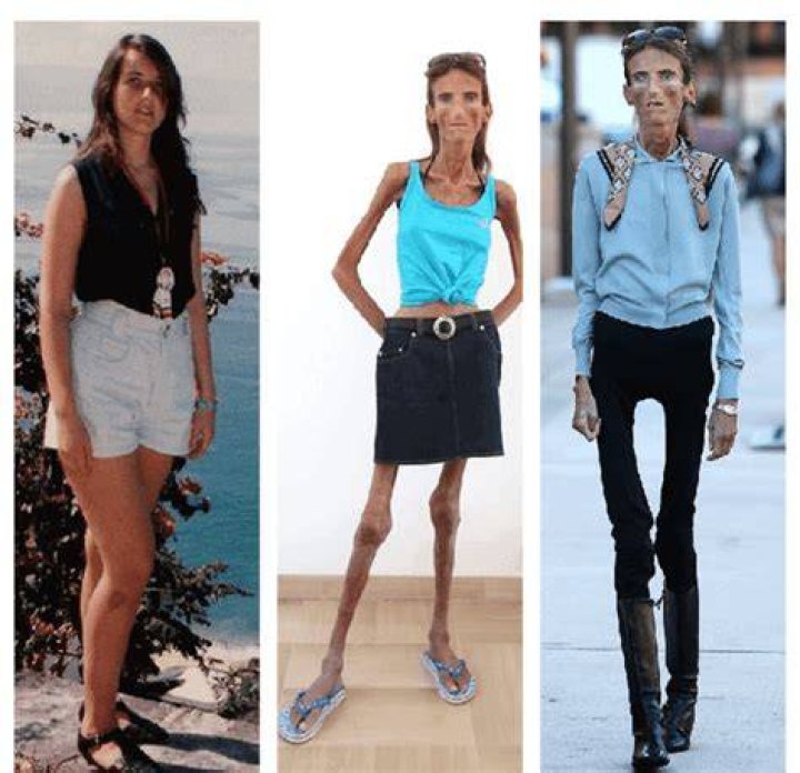 Exploring the Life of the World's Skinniest Person: A Fascinating Journey