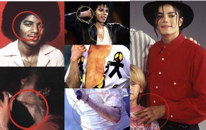 Vitiligo Michael Jackson Skin Condition: Understanding the Life and Legacy